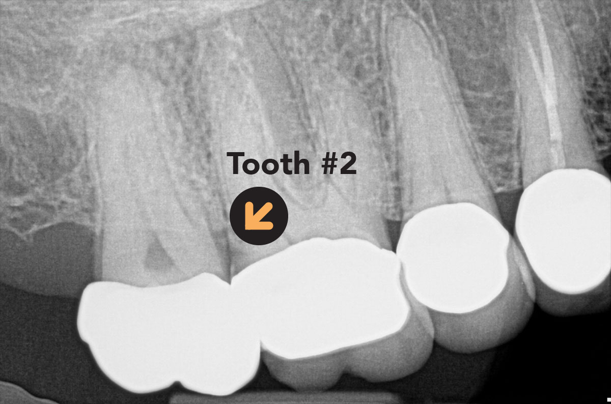 Image showing periapical radiograph of Tooth 2