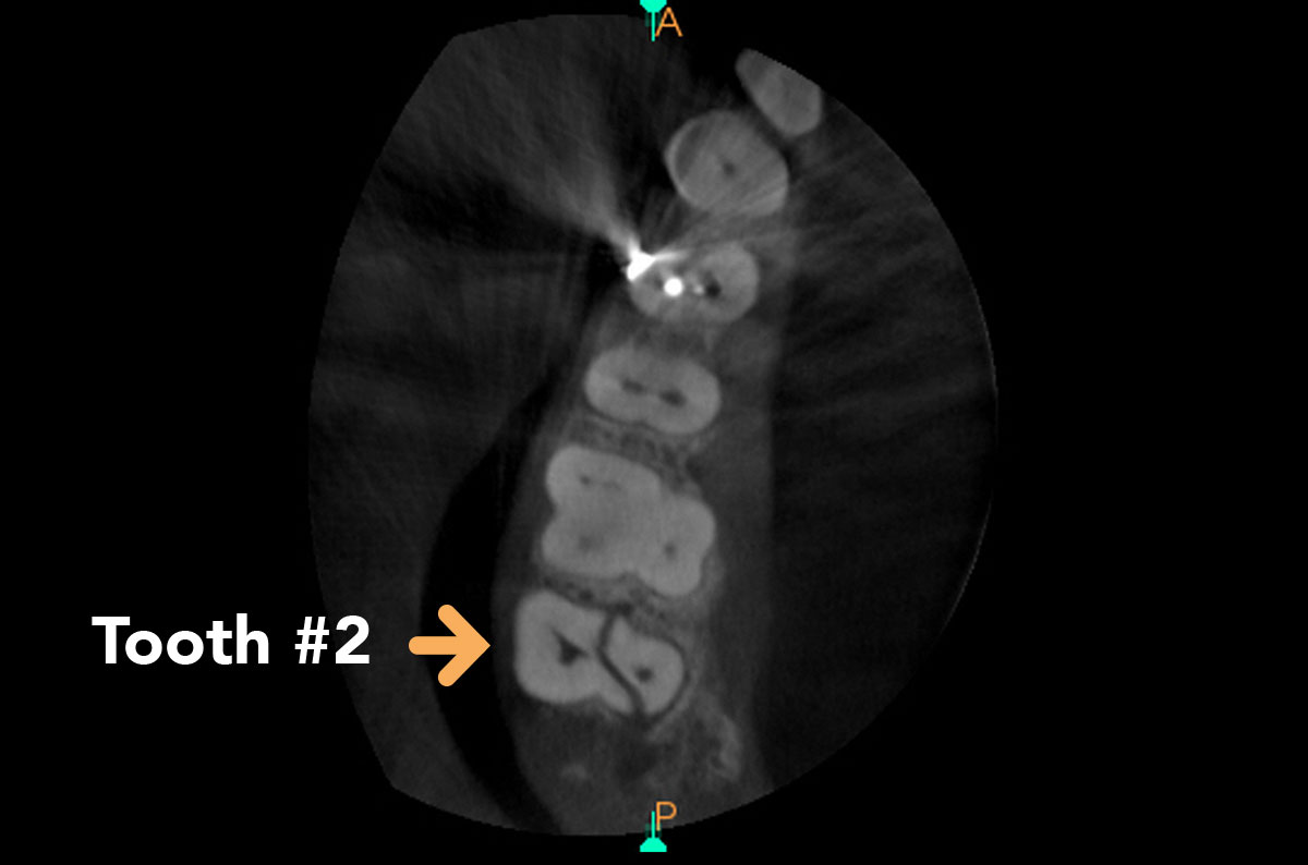 Image showing Axial slice of Tooth 2